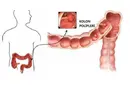 Kolon Polipleri Nelerdir? Kolon Polipleri Nelerdir?