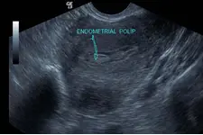 Endometrial Polip Nedir? Endometrial Polip Nedir?