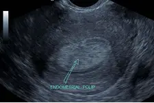 Endometrial Polip Nedir?