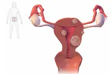 Polip Nedir? Polip Oluşma Nedenleri Polip Nedir? Polip Oluşma Nedenleri