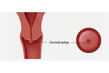 Servikal Polip Belirtileri ve Tedavisi