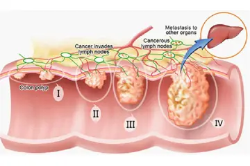 Bağırsakta Polip Belirtileri ve Tedavisi