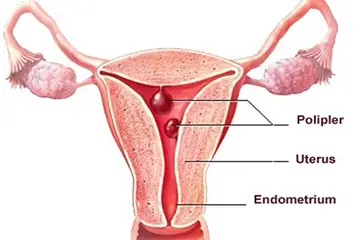 Rahimde Polip Belirtileri ve Tedavisi